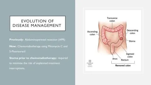 Representative slide from Investigating Stoma Outcomes in Patients Undergoing Chemoradiotherapy for Anal Squamous Cell Carcinoma (SCCA)