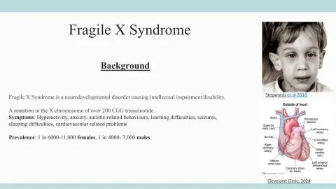 Representative slide from Literature Review: Cardiovascular Abnormalities In Fragile X Syndrome